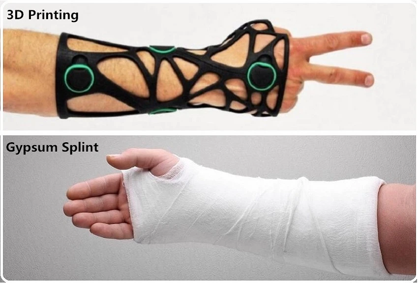 3D Printed Casts 1 3D Printed Casts 1